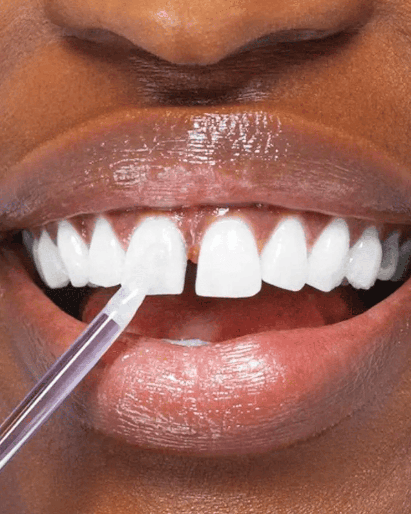 GlorySmile® WhitePen Pro