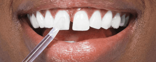 Penna Sbiancante Denti PAP+: La Rivoluzione Portatile per un Sorriso Bianco Ovunque Tu Sia